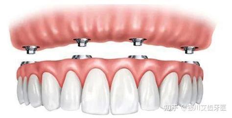 缺四颗牙为何种两棵种植体挂两颗牙冠?-图1 缺四颗牙为何种两棵种植体挂两颗牙冠?-图1