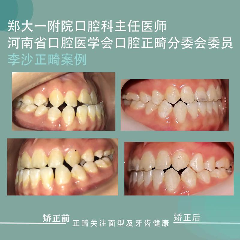 安徽省口腔医院牙齿正畸效果好不好？价格贵不贵？适合哪些人群？-图3