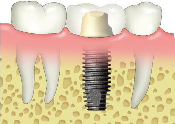 即拔即种牙一颗价格是多少?-图1 即拔即种牙一颗价格是多少?-图1