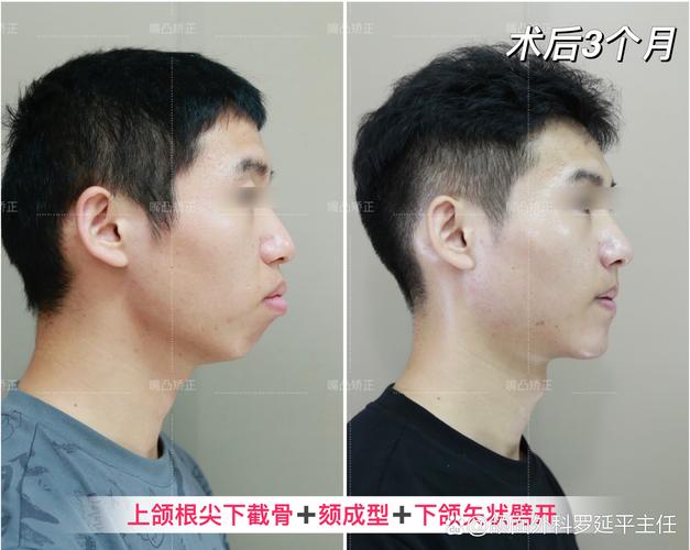 正颌正畸与口腔颌面外科,有何区别与关联?-图3 正颌正畸与口腔颌面外科,有何区别与关联?-图3