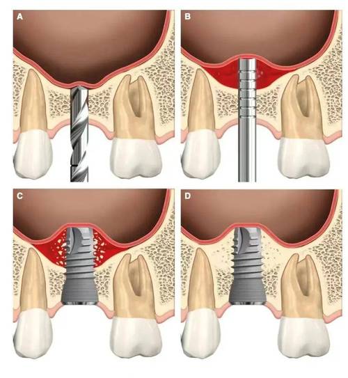 植骨和种牙是一起的吗-图1