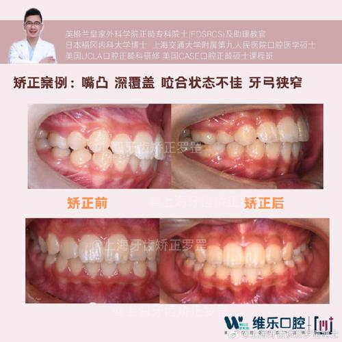 正畸倾斜的牙如何拉正的-图3 正畸倾斜的牙如何拉正的-图3