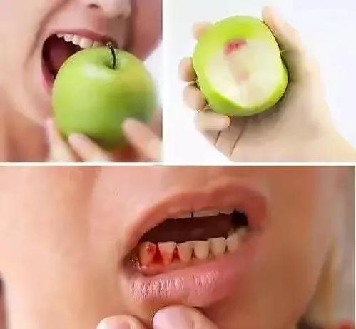 种牙后三天了一直流血，正常吗？该怎么办？-图3
