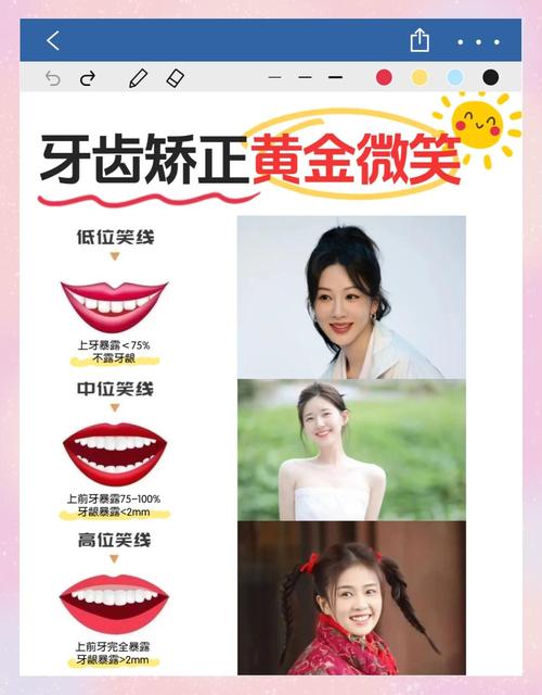 正畸笑线调整，真的要等到最后吗？-图2