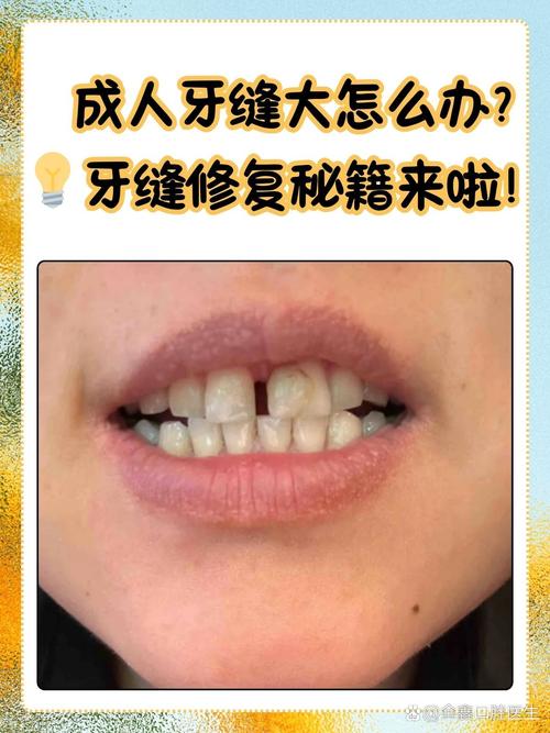门牙有缝的最好修补方法-图2