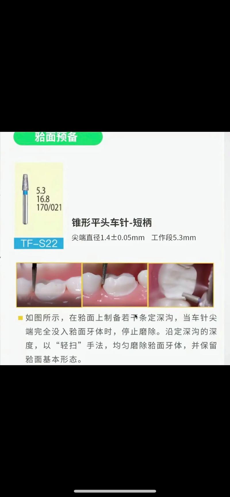 牙体预备光滑连续的方法-图1 牙体预备光滑连续的方法-图1