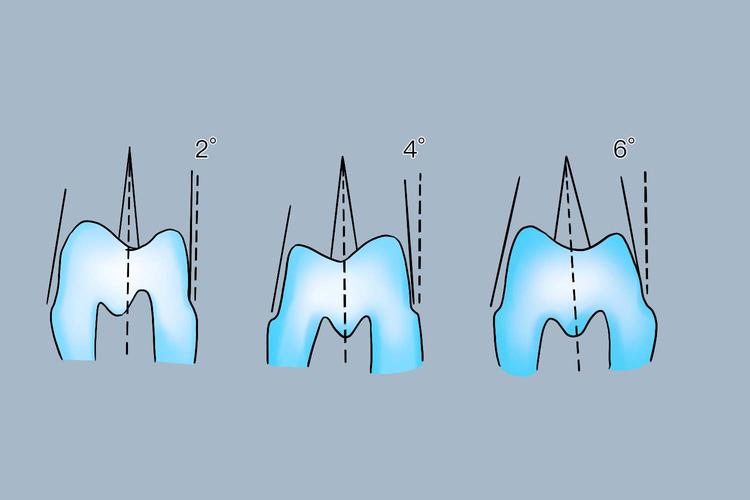 牙体预备光滑连续的方法-图2