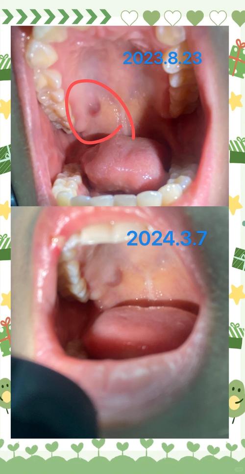 正畸上颚粘的东西是什么？有何作用？-图1