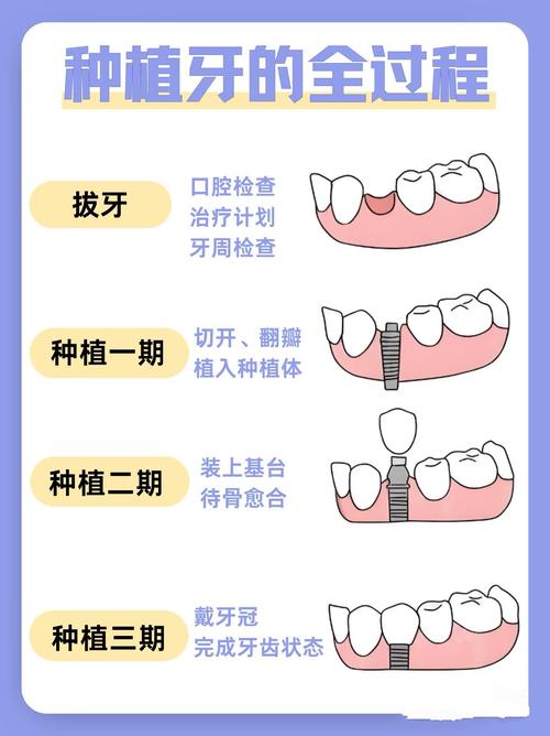 种植牙哪一种性价比高-图3