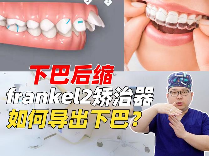 正畸法兰克2改良做法有何独特优势?-图1 正畸法兰克2改良做法有何独特优势?-图1