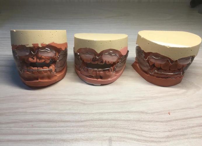 正畸法兰克2改良做法有何独特优势?-图3 正畸法兰克2改良做法有何独特优势?-图3