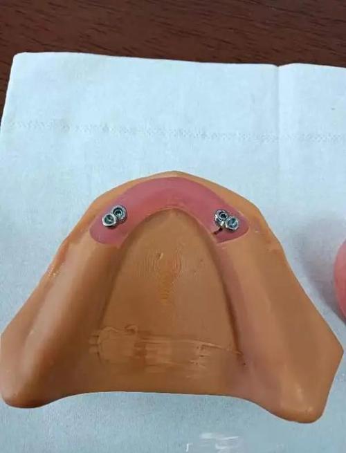 拜博口腔医院假牙安装-图2 拜博口腔医院假牙安装-图2