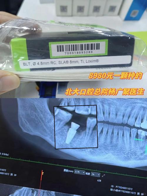 北大口腔医院西四种牙-图3