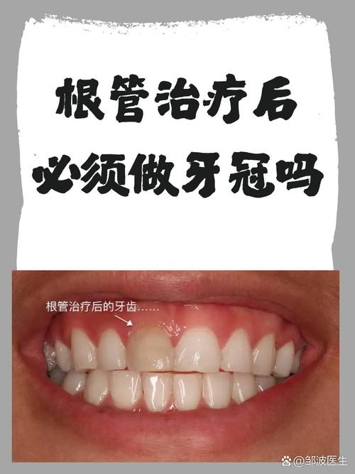 拜博口腔根管治疗保质-图1