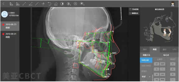 北医正畸头颅测量分析法有何独特优势与应用价值?-图3 北医正畸头颅测量分析法有何独特优势与应用价值?-图3