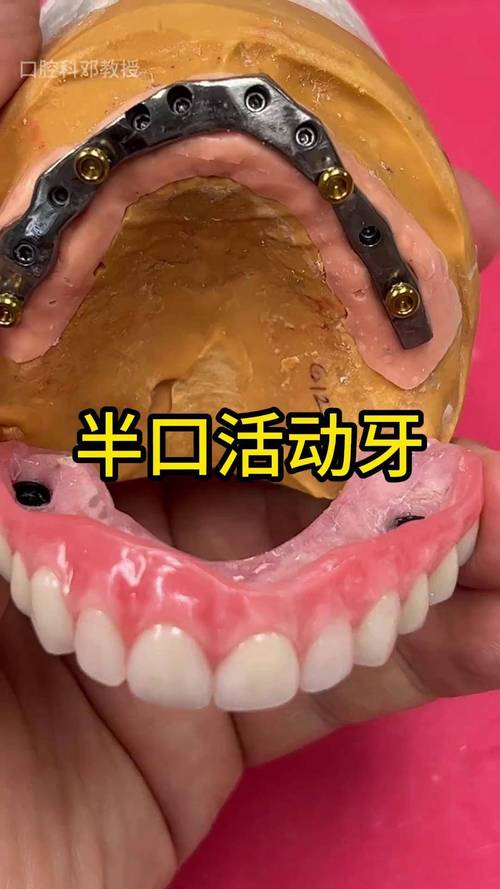 活动假牙戴牙方法视频,正确佩戴步骤是怎样的?-图2 活动假牙戴牙方法视频,正确佩戴步骤是怎样的?-图2