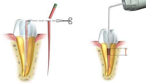 根管测定工作长度的方法-图1