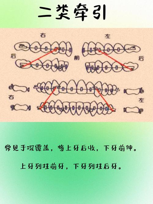 牙正畸近中牵引的作用有哪些？-图1