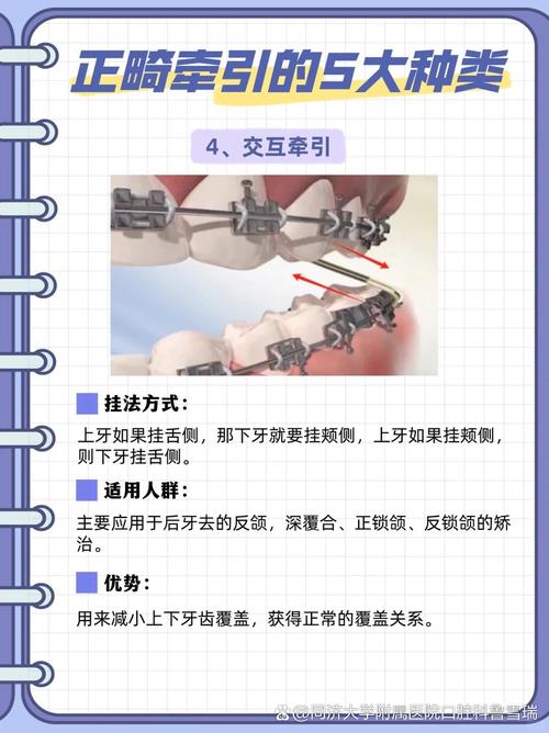 牙正畸近中牵引的作用有哪些?-图3 牙正畸近中牵引的作用有哪些?-图3