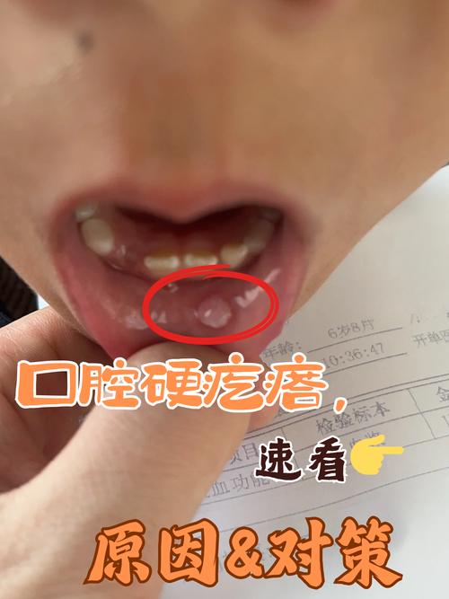 口腔壁增生怎么治?有哪些有效治疗方法?-图1 口腔壁增生怎么治?有哪些有效治疗方法?-图1