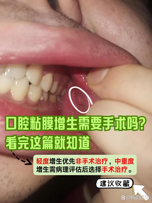 口腔壁增生怎么治?有哪些有效治疗方法?-图2 口腔壁增生怎么治?有哪些有效治疗方法?-图2