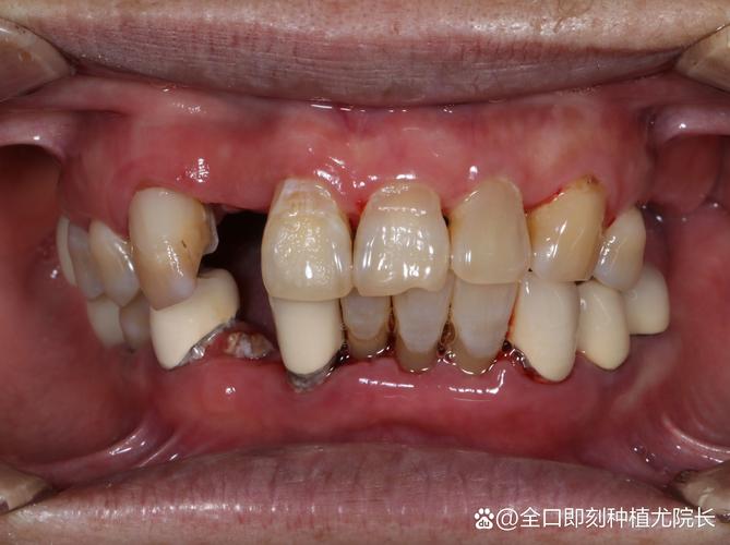 牙种深了会有什么问题吗？-图1