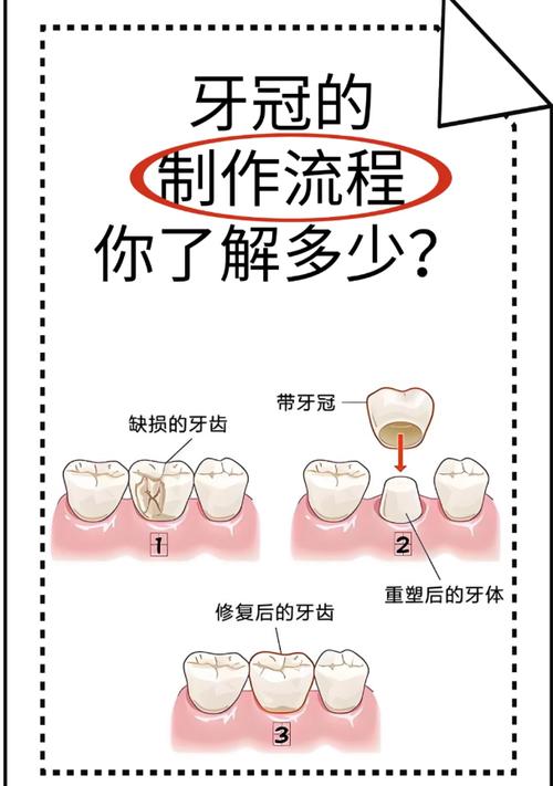 牙体缺损粘结修复有哪些常用方法?-图2 牙体缺损粘结修复有哪些常用方法?-图2