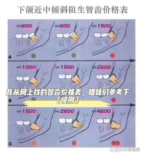 拔智齿加种牙要多少钱-图3 拔智齿加种牙要多少钱-图3