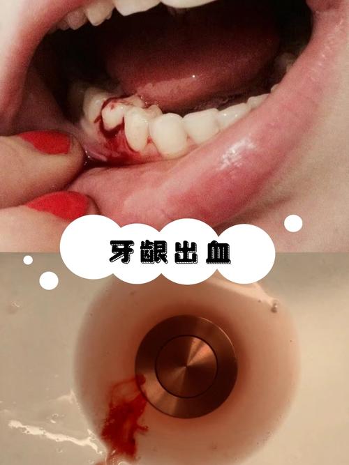 牙龈出血怎么治?常见有效方法有哪些?-图3 牙龈出血怎么治?常见有效方法有哪些?-图3