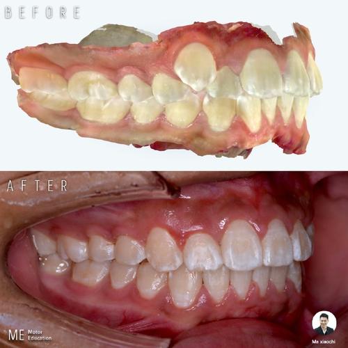 正畸不拔牙vs拔牙，到底该怎么选？效果差异大吗？-图2