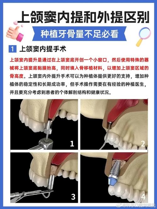 种牙内提和外提的区别究竟是什么?-图1 种牙内提和外提的区别究竟是什么?-图1