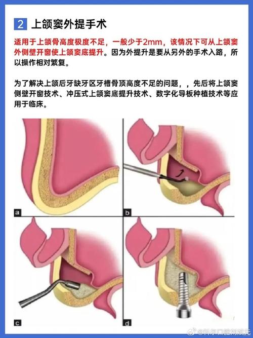 种牙内提和外提的区别究竟是什么?-图2 种牙内提和外提的区别究竟是什么?-图2