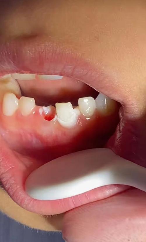 牙齿脱落一年后，还能种牙吗？-图1