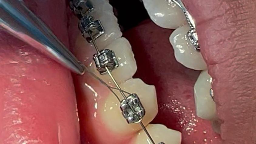 正畸金属自锁最后面钢丝有何关键作用？-图3