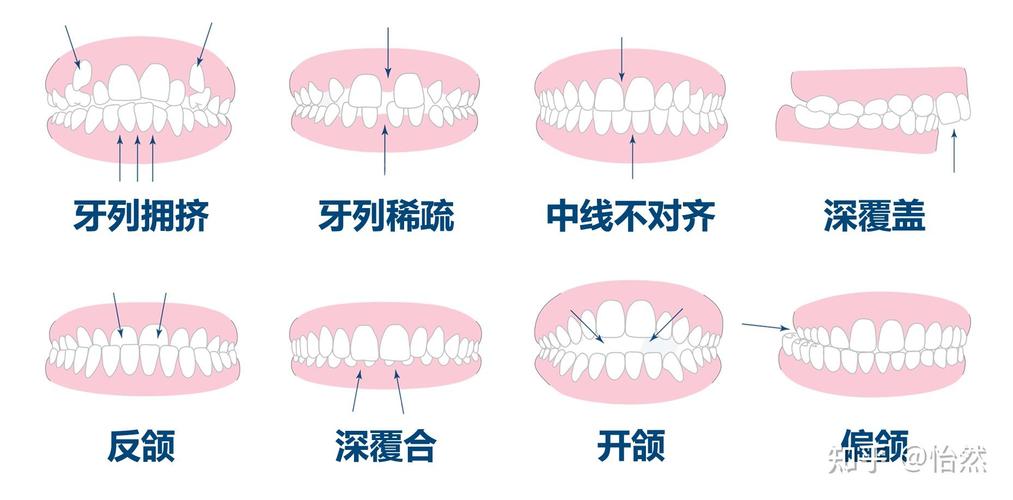 正畸近远中关系具体指什么?-图1 正畸近远中关系具体指什么?-图1