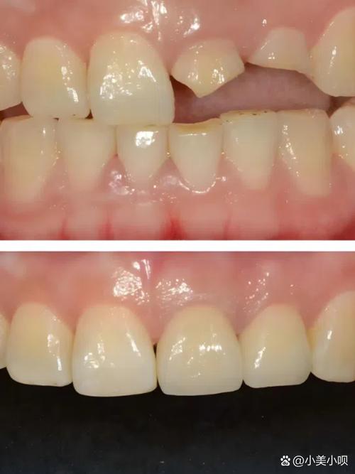 种一牙六千韩国烤瓷牙,价格合理质量有保障吗?-图3 种一牙六千韩国烤瓷牙,价格合理质量有保障吗?-图3