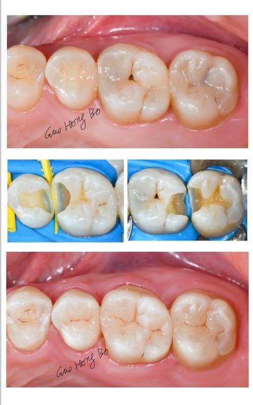 树脂牙齿抛光最简单方法-图1 树脂牙齿抛光最简单方法-图1