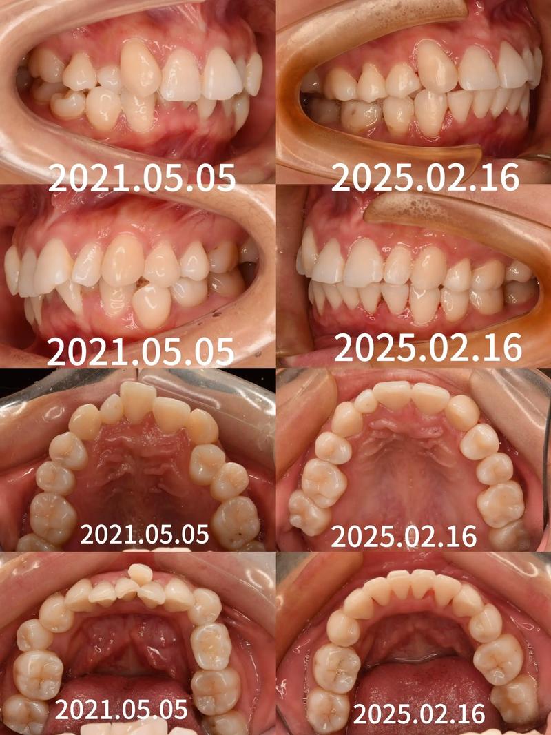 正畸过程中怀孕了，牙齿矫正是否可以继续进行？-图3