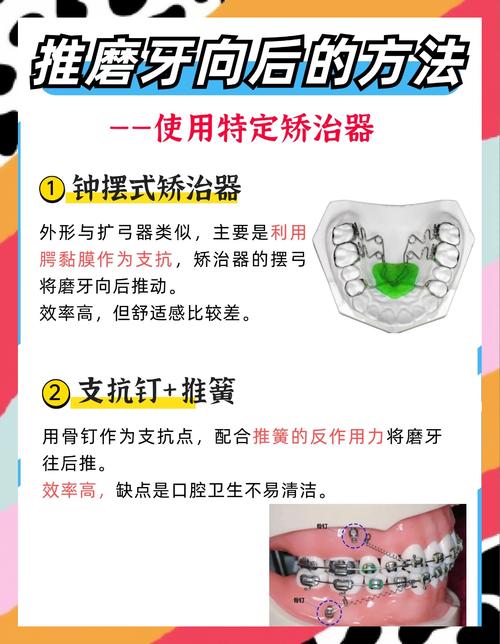 加强后牙支抗有哪几种方法?各自适用什么情况?-图3 加强后牙支抗有哪几种方法?各自适用什么情况?-图3