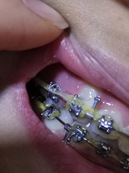 拜博口腔医院矫正牙齿-图2
