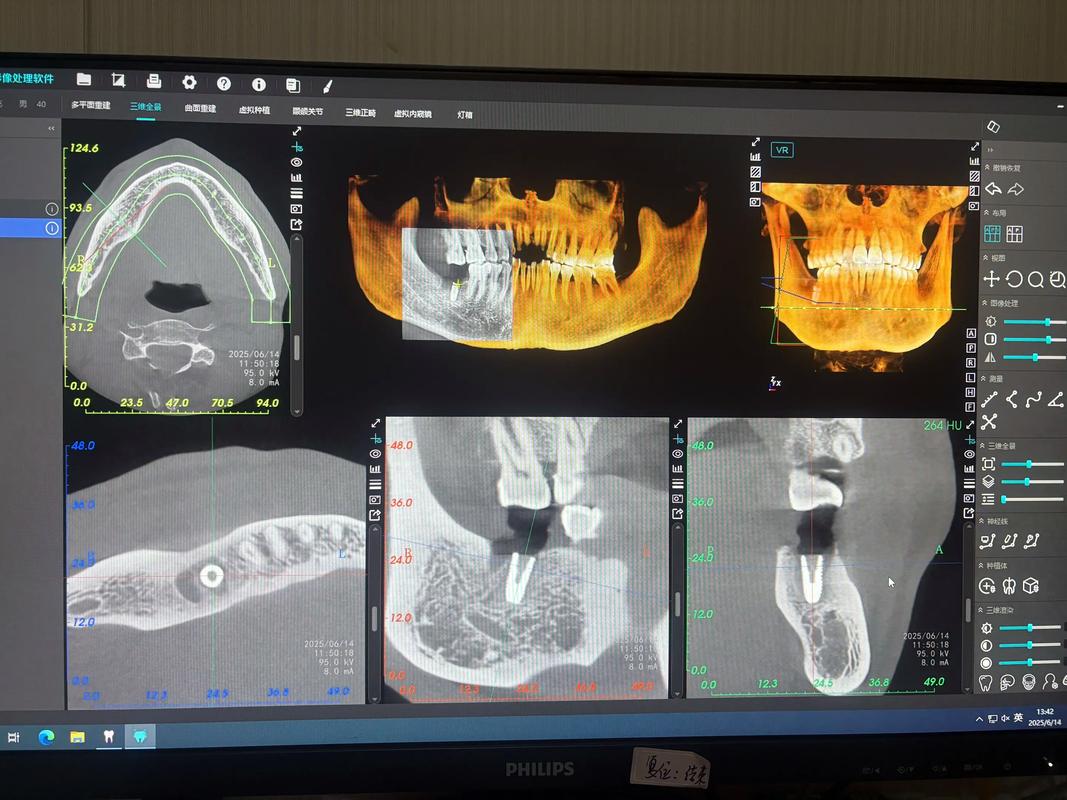 即拔即种牙从哪来?揭秘其来源之谜-图2 即拔即种牙从哪来?揭秘其来源之谜-图2