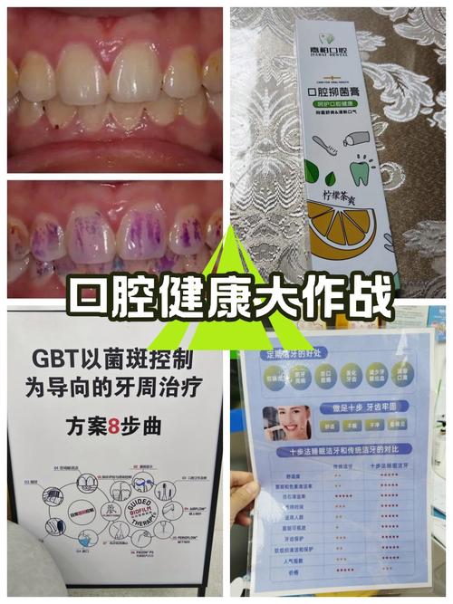 机械性控制菌斑的常用方法具体有哪些及如何操作？-图1