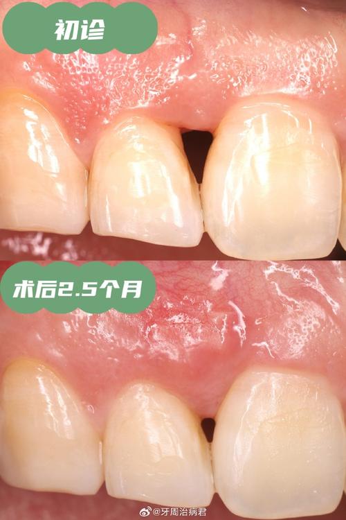 牙周骨手术后正畸治疗的最佳时机及效果如何把握?-图1 牙周骨手术后正畸治疗的最佳时机及效果如何把握?-图1