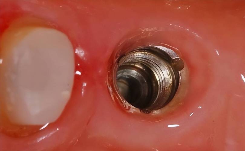人工种植牙种植体种入的详细操作步骤和注意事项是什么？-图1