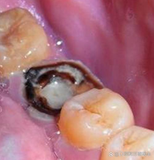 种牙会引起血压升高吗?-图2 种牙会引起血压升高吗?-图2