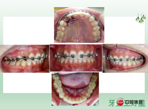 高水平近中阻生可以正畸-图2