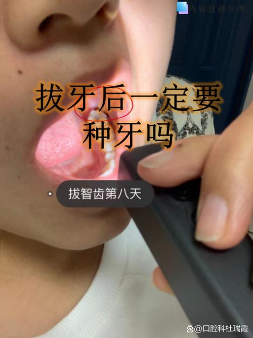 拔牙一年后还能种牙吗?-图1 拔牙一年后还能种牙吗?-图1