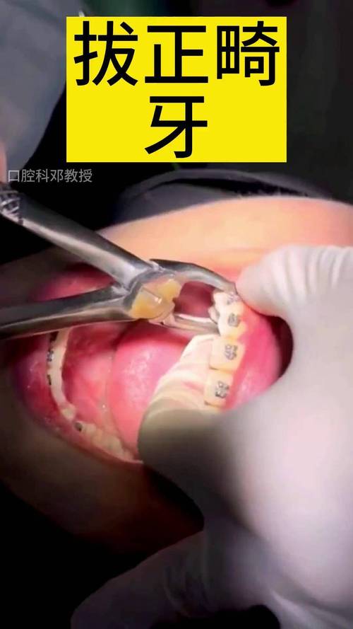 正畸时，横向阻生齿是否必须拔除？不拔会影响矫正效果吗？-图1