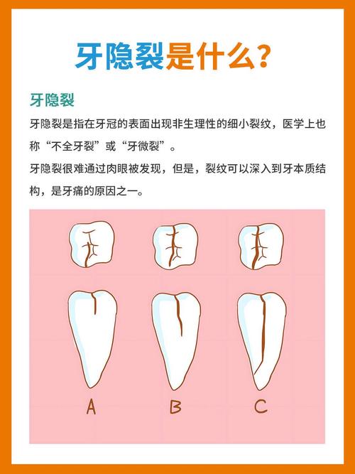 牙齿裂开最好的解决方法是什么?-图1 牙齿裂开最好的解决方法是什么?-图1