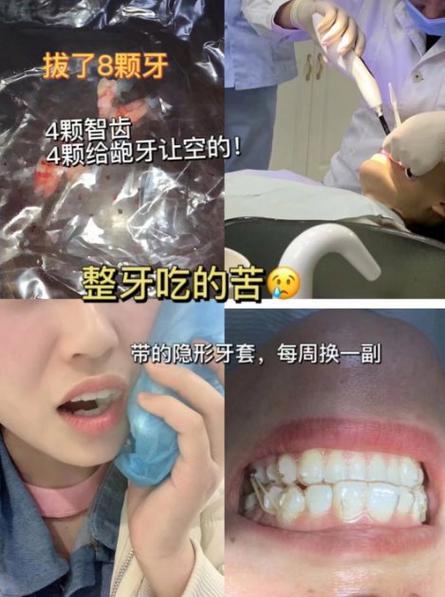 正畸快结束为何需再治疗深覆颌?-图3 正畸快结束为何需再治疗深覆颌?-图3
